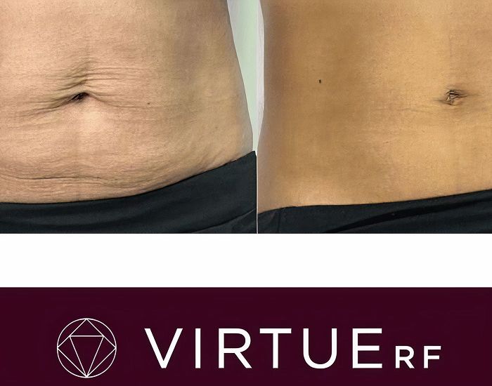 Before and after body skin treatment comparison.