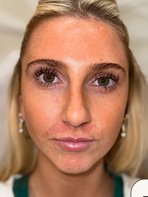Chin Filler Gallery Before & After