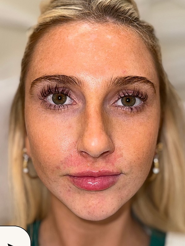 Chin Filler Gallery Before & After
