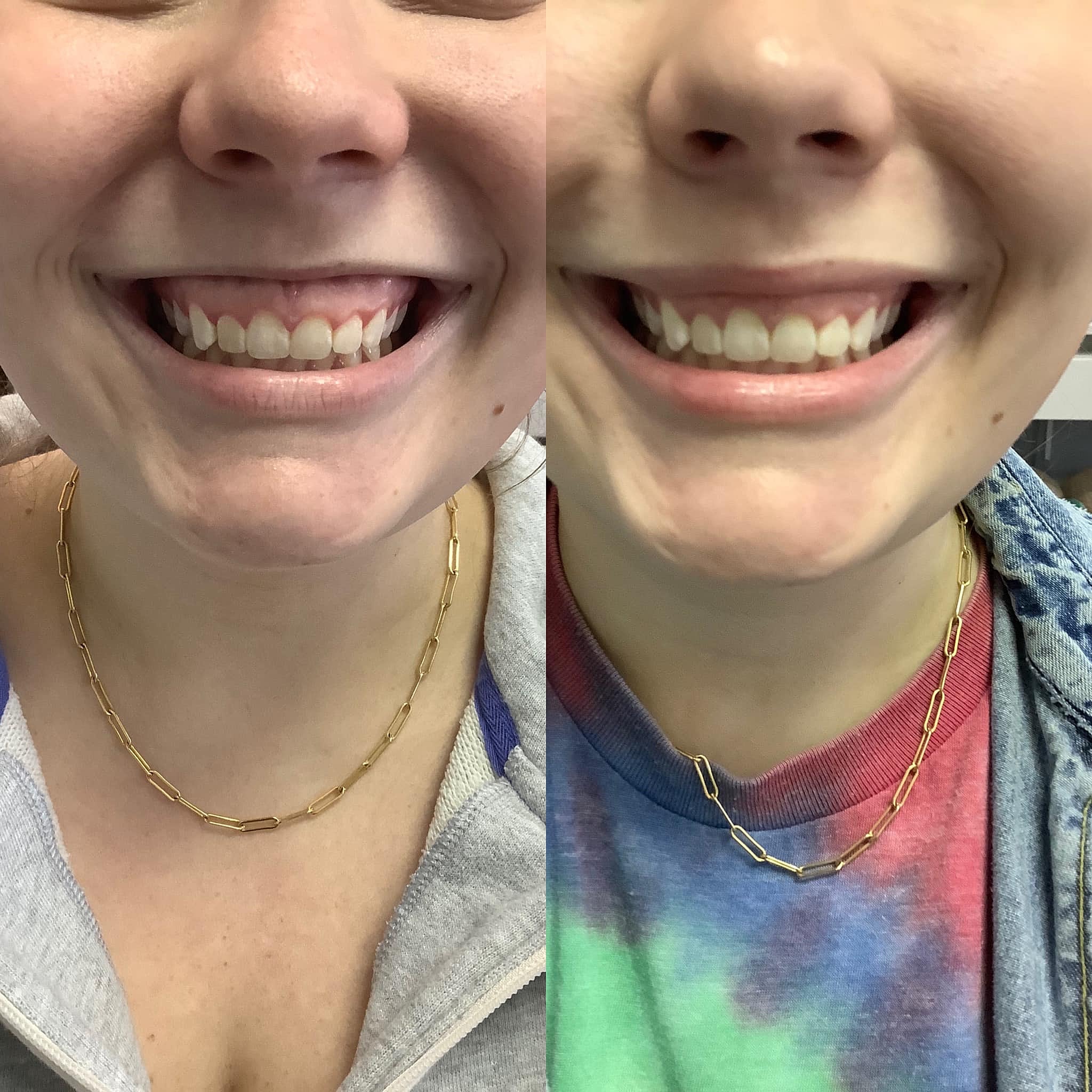 Alternative Uses for Toxins & Fillers