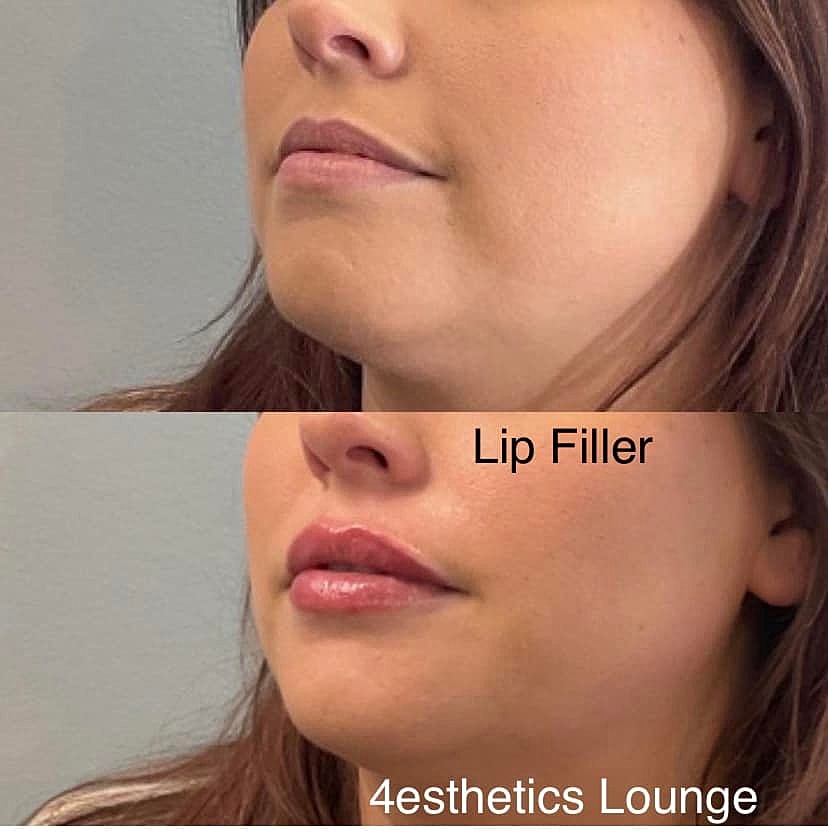 August Promo: $100 filler and toxin!