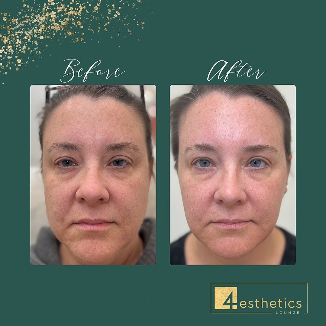 Common Questions About CO2 Laser & CoolPeel