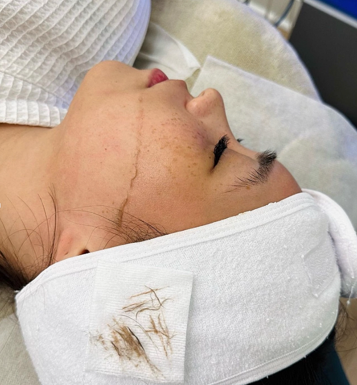 Dermaplaning: Shed the Dead