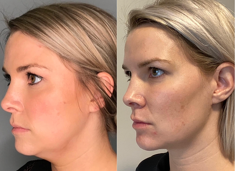 Dissolve Your Double Chin