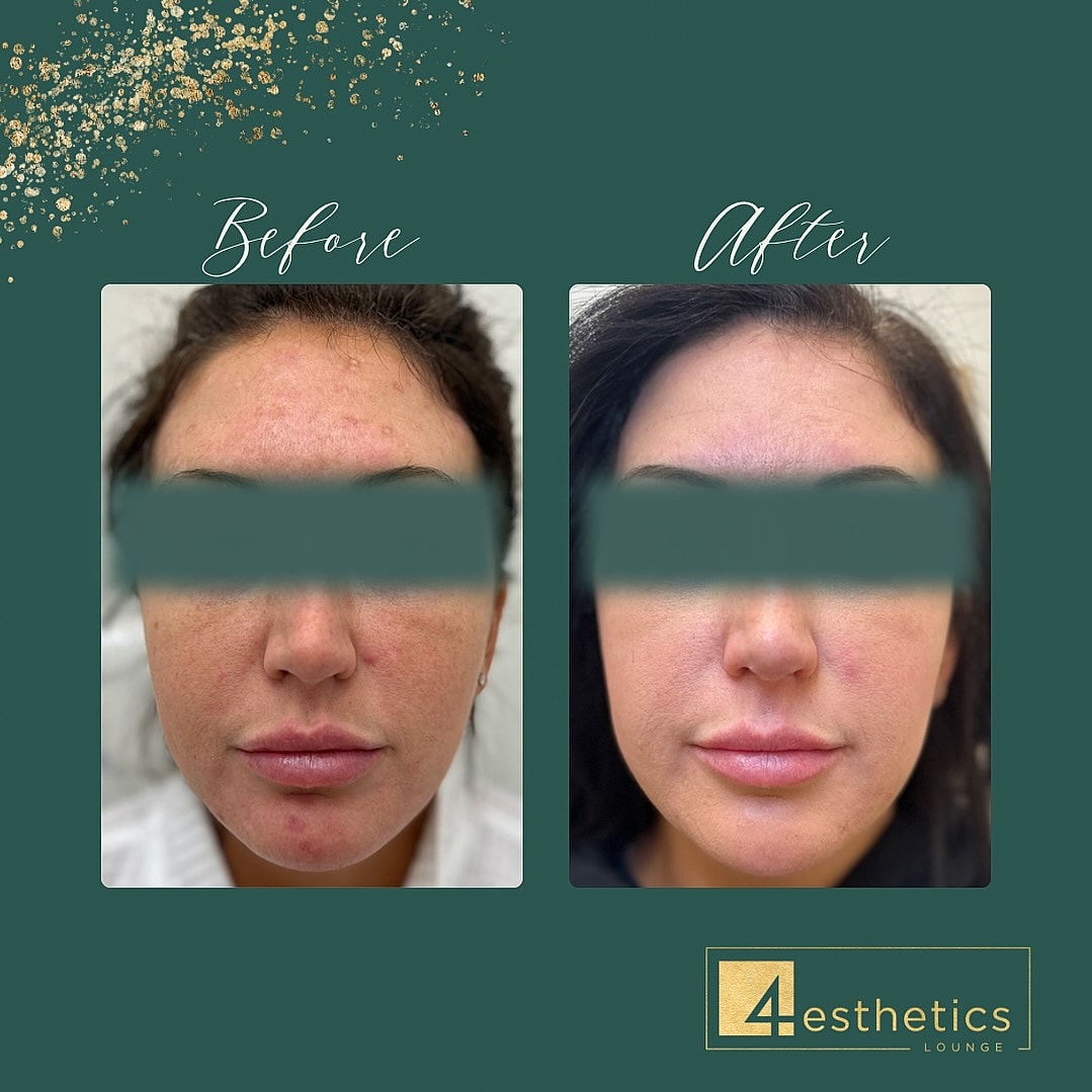 Downtime From Skin Resurfacing