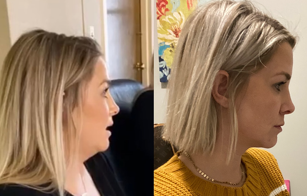 Kybella is a Permanent Fat Dissolving Injection