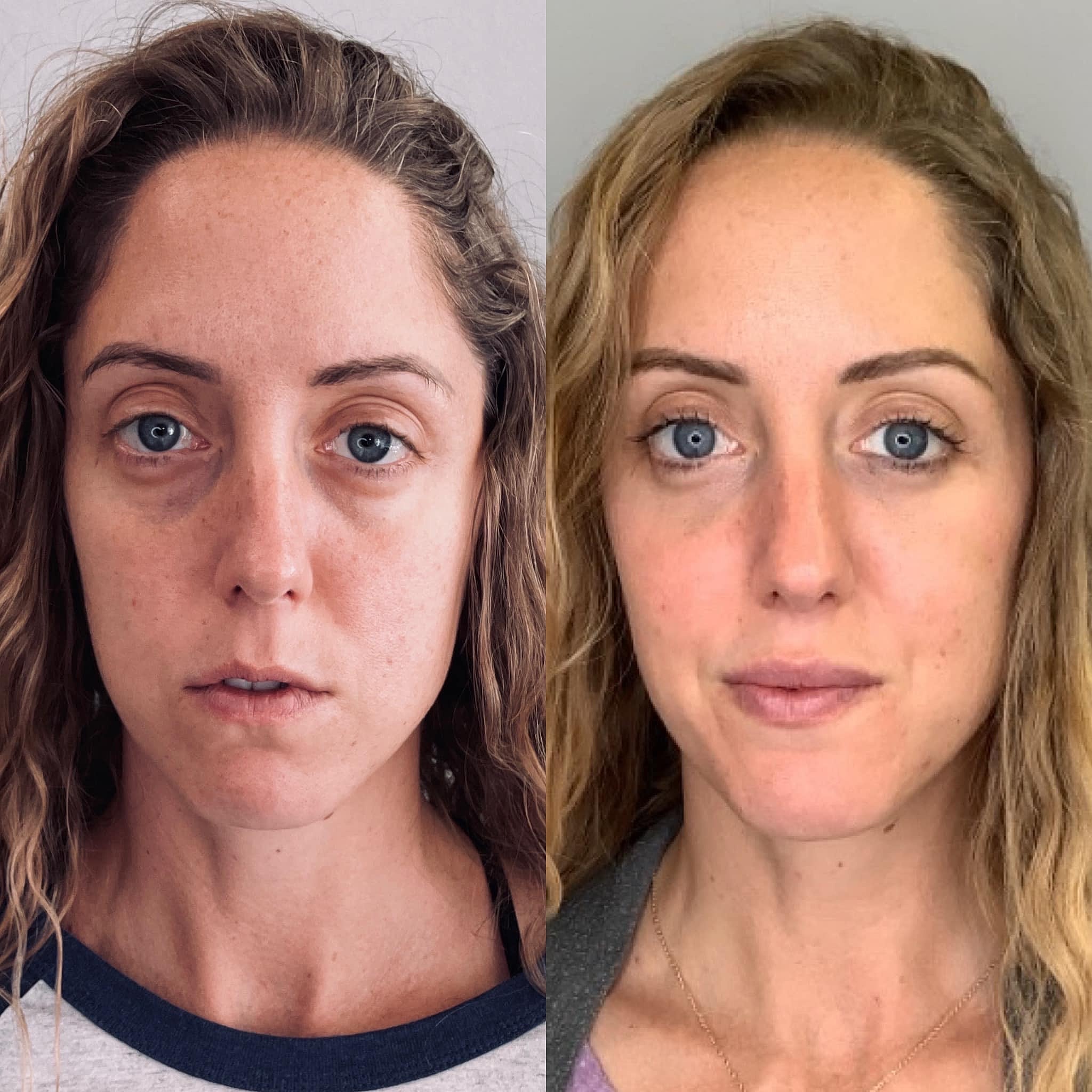 Natural & Subtle Volume