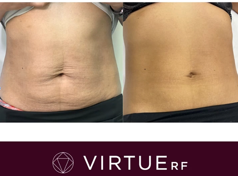 Radiofrequency Microneedling