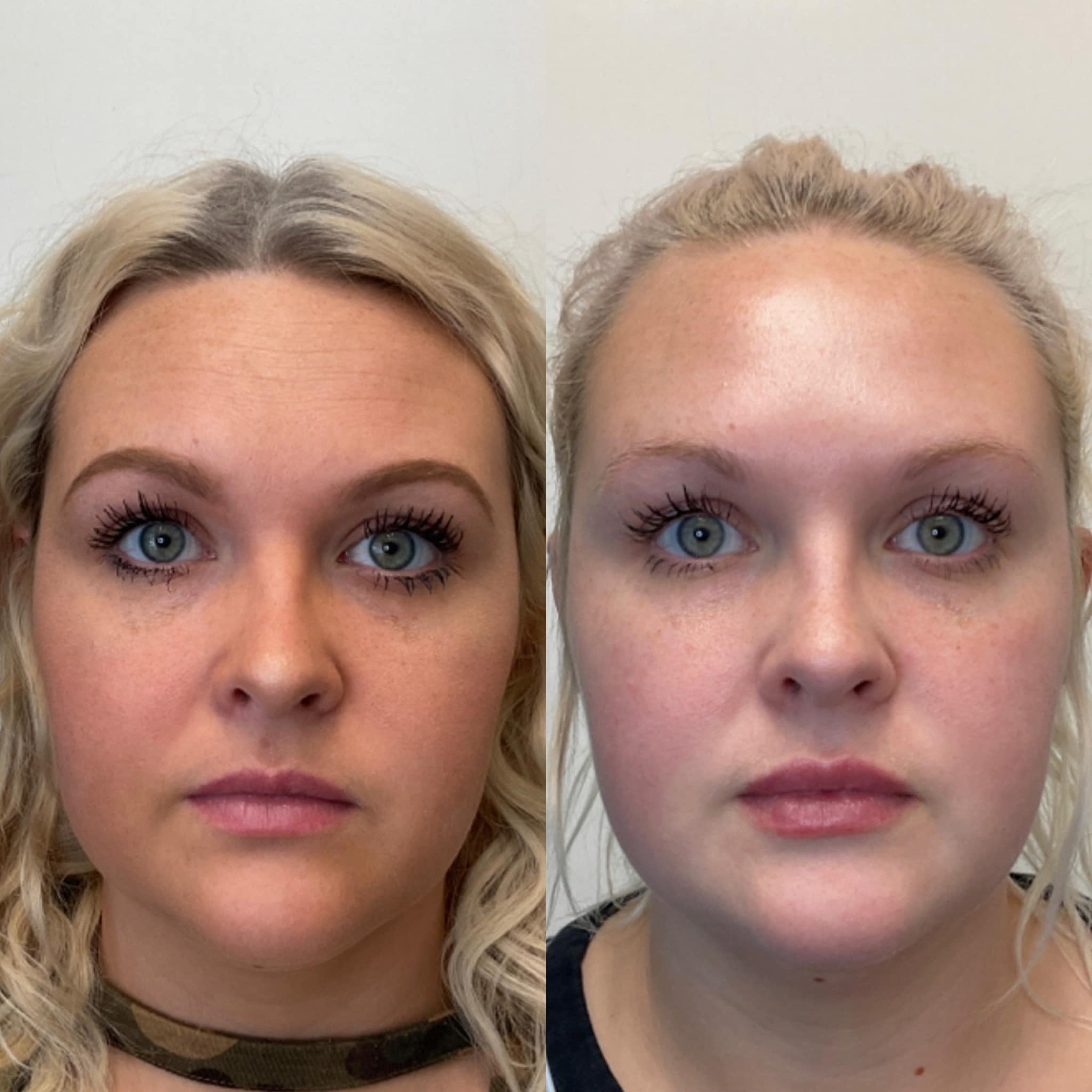 Toxins Are Great Wrinkle Relaxers