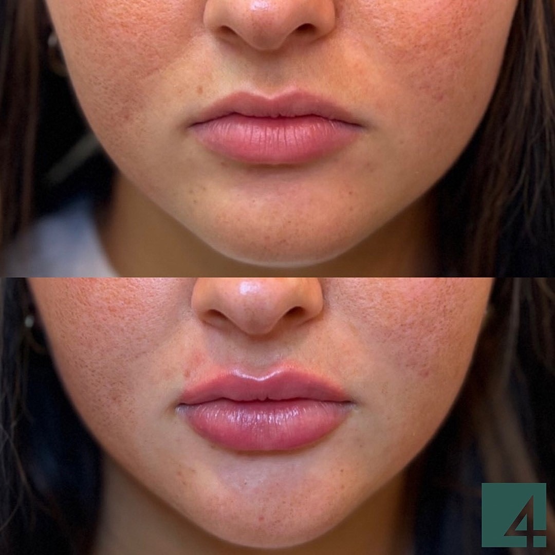 Treating Downturned Smiles