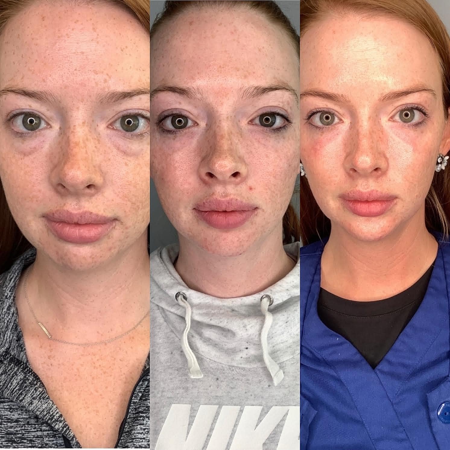 What You Need To Know Before Getting Filler