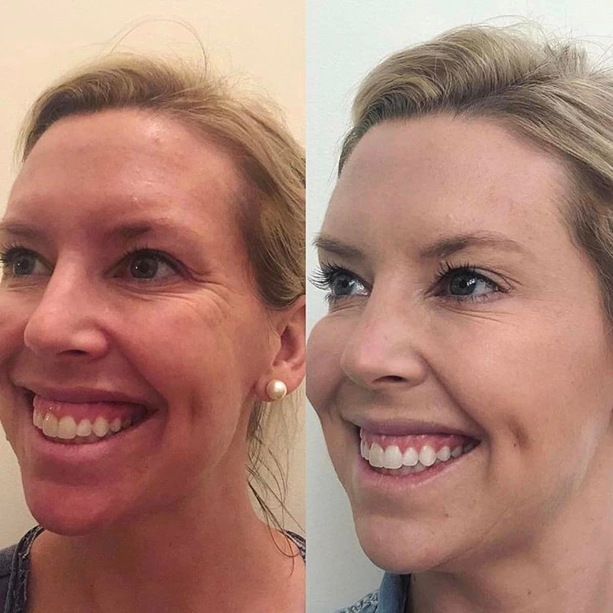 Why Pre-Plan Your Toxin Appointments